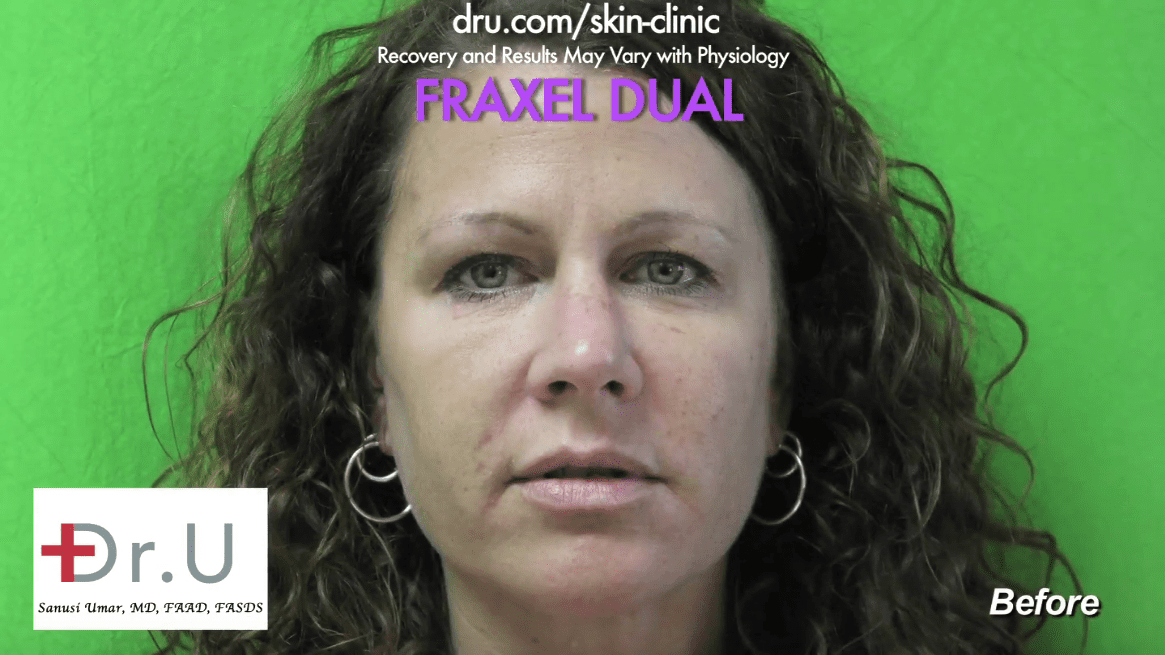 With Fraxel Dual laser, it is possible to get rid of brown spots caused by sun and aging.* With Fraxel Dual laser, it is possible to get rid of brown spots caused by sun and aging.*
