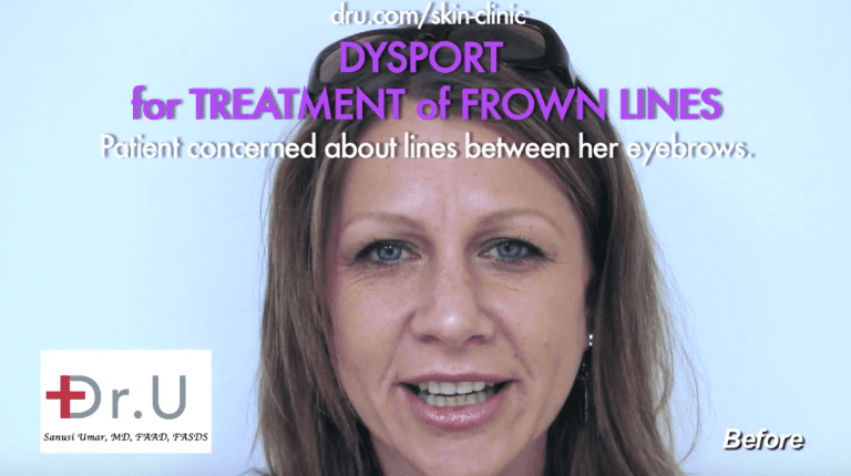 Get rid of furrow lines between eyebrows with Dysport at Dr. U Hair & Skin Clinic.* Get rid of furrow lines between eyebrows with Dysport at Dr. U Hair & Skin Clinic.*