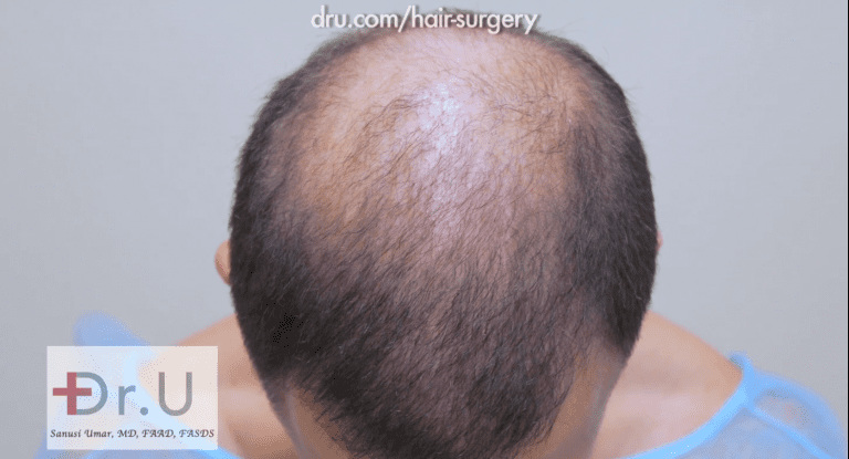 This patient was faced with not enough hair transplant donor grafts due to the limited hair left on his head This patient was faced with not enough hair transplant donor grafts due to the limited hair left on his head