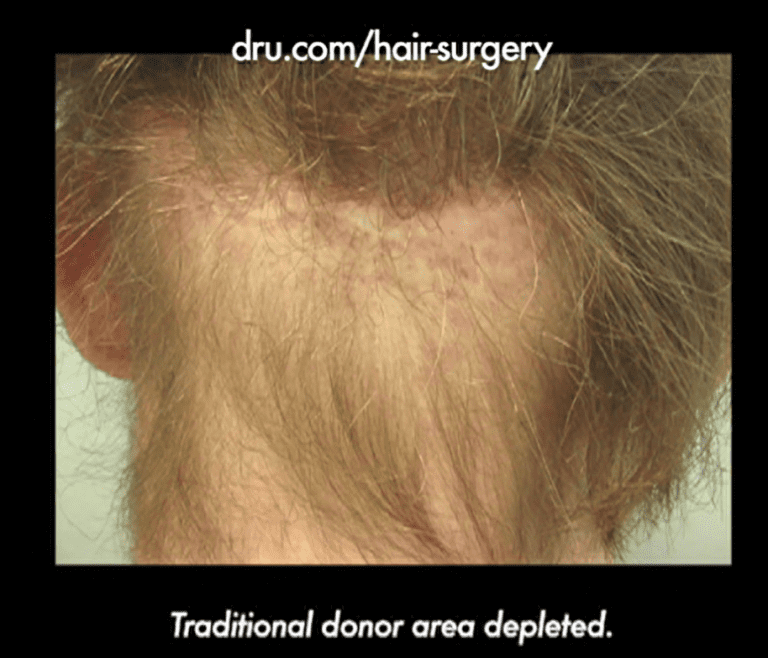 This patient's experience of hair transplant surgery gone wrong multiple times left him with his traditional donor area depleted This patient's experience of hair transplant surgery gone wrong multiple times left him with his traditional donor area depleted
