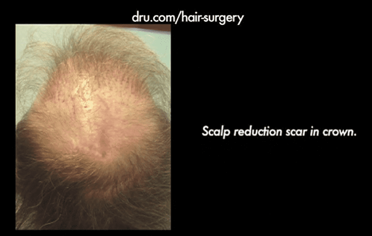 V-shaped scar remaining on top of the patient's head that resulted from a scalp reduction, failed hair restoration procedure V-shaped scar remaining on top of the patient's head that resulted from a scalp reduction, failed hair restoration procedure