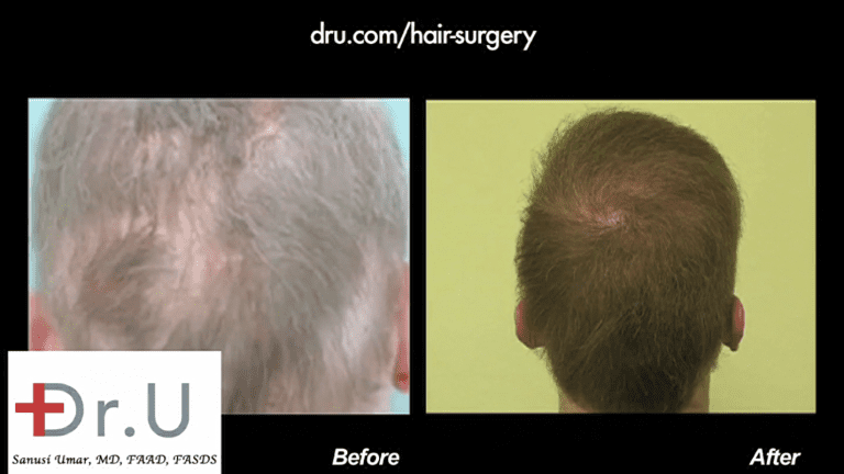 The back of the patient's head now has normal looking coverage thanks to body hair grafts that were well inserted to recreate the whorl and normal growth patterns on the back of the head The back of the patient's head now has normal looking coverage thanks to body hair grafts that were well inserted to recreate the whorl and normal growth patterns on the back of the head