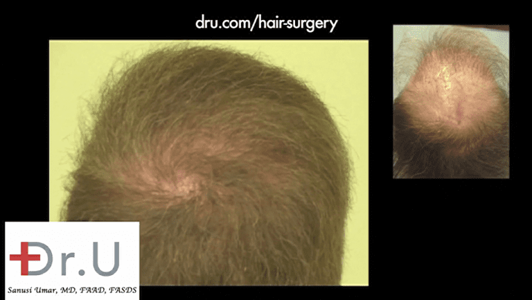 Close up view of crown whorl and new coverage which now masks the scalp reduction scar Close up view of crown whorl and new coverage which now masks the scalp reduction scar