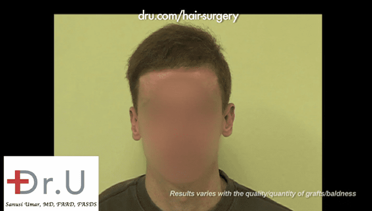 Dr. Umar was indeed the best hair restoration repair doctor who succeeded in restoring a normal looking coverage Dr. Umar was indeed the best hair restoration repair doctor who succeeded in restoring a normal looking coverage