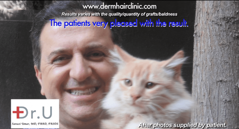 happy patient after hair transplant with 14,000 grafts happy patient after hair transplant with 14,000 grafts