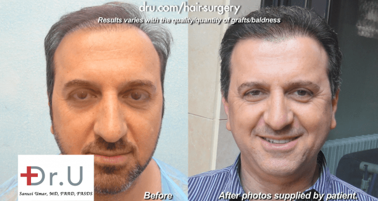 Patient's Hair Transplant With 14,000 Grafts - Before and After Patient's Hair Transplant With 14,000 Grafts - Before and After