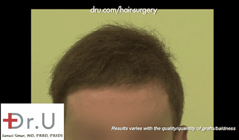 Patient's new hairline now lets him put his hair transplant disasters behind him Patient's new hairline now lets him put his hair transplant disasters behind him