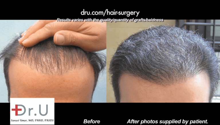 Body Hair Transplant Procedure to Fix Pluggy Hairline - Before and After Photos Body Hair Transplant Procedure to Fix Pluggy Hairline - Before and After Photos