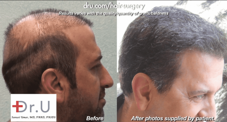Side view of no hair growth yield compared to final body hair transplant outcome Side view of no hair growth yield compared to final body hair transplant outcome