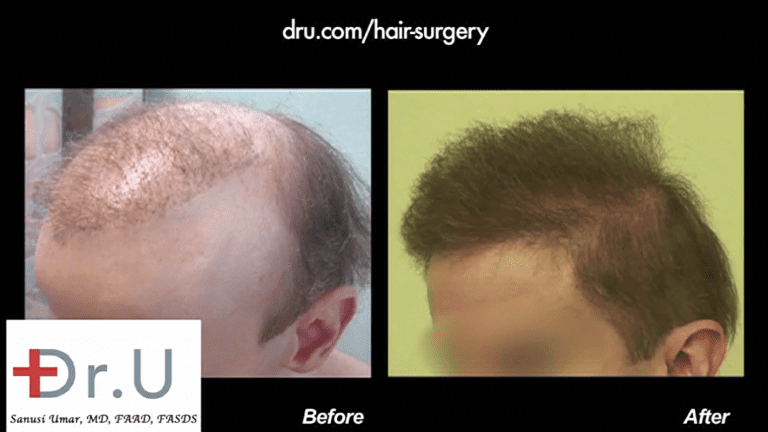 Patient is now able to put the signs of failed hair restoration behind him with his amazing new coverage which includes well-designed temples that frame his face in the best way possible Patient is now able to put the signs of failed hair restoration behind him with his amazing new coverage which includes well-designed temples that frame his face in the best way possible