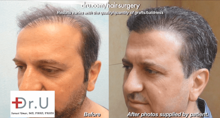 before and after surgery with Dr. U to repair a botched hair transplant outcome before and after surgery with Dr. U to repair a botched hair transplant outcome