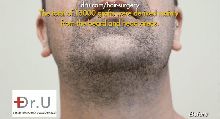 Patient's beard area before his surgery with Dr. Umar Patient's beard area before his surgery with Dr. Umar