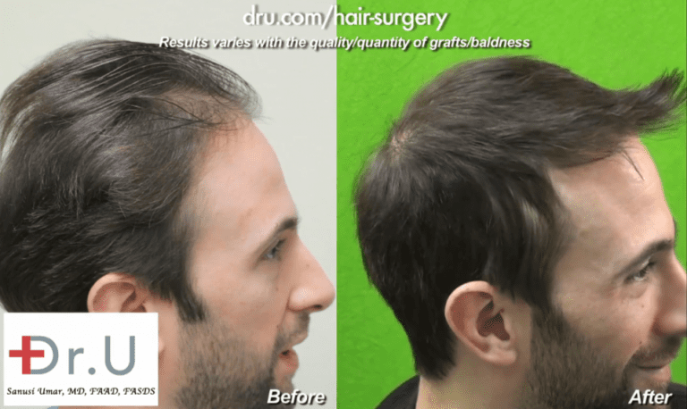 Hollywood, Los Angeles patient shown from the side before and after his celebrity hair restoration Hollywood, Los Angeles patient shown from the side before and after his celebrity hair restoration