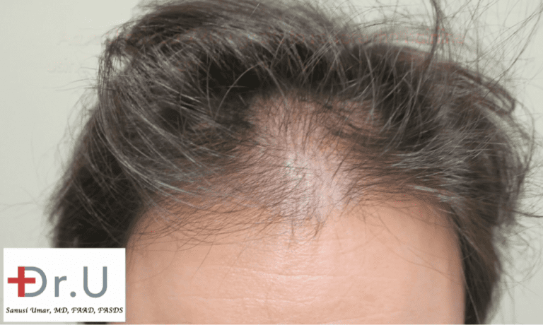 An FUE procedure at Dr. U's clinic was chosen to recreate a hairline and temples in celebrity An FUE procedure at Dr. U's clinic was chosen to recreate a hairline and temples in celebrity
