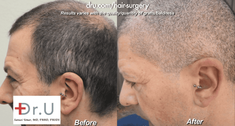 Beard and head hair grafts were used to conceal strip scars. Here are before and after photos Beard and head hair grafts were used to conceal strip scars. Here are before and after photos
