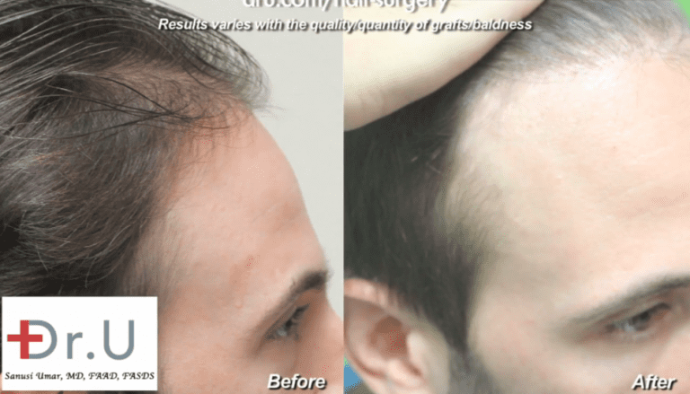 Dr. Umar was able to recreate hairline and temples in a celebrity Dr. Umar was able to recreate hairline and temples in a celebrity