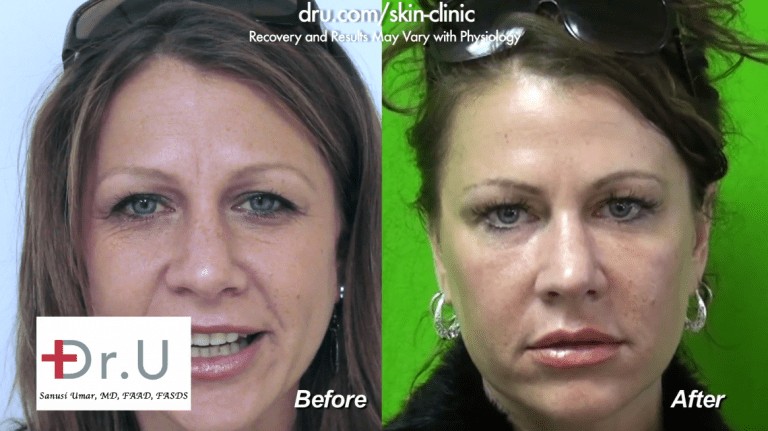 Dysport in forehead before and after proved highly effective and natural-looking for this Dr. U patient.* Dysport in forehead before and after proved highly effective and natural-looking for this Dr. U patient.*