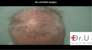 This patient required a body hair transplant for impossible repair due to the aftermath of procedures like flap surgery for hair restoration. This patient required a body hair transplant for impossible repair due to the aftermath of procedures like flap surgery for hair restoration.