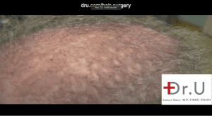 Manhattan Beach, Los Angeles patient shown before his Dr.UGraft procedure to repair punch graft hair restoration scars Manhattan Beach, Los Angeles patient shown before his Dr.UGraft procedure to repair punch graft hair restoration scars