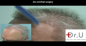 This patient required a body hair transplant for repairing a donor depleted scalp. This before and after image highlights the left temple oblique view, showing improved overall coverage and natural looking hairline and temples constructed with body donor hair. This patient required a body hair transplant for repairing a donor depleted scalp. This before and after image highlights the left temple oblique view, showing improved overall coverage and natural looking hairline and temples constructed with body donor hair.