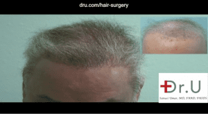Dr. Umar used abdomen, beard and chest hair to repair a flap surgery hairline scar and achieve a natural-looking coverage for the top of this patient's head. Dr. Umar used abdomen, beard and chest hair to repair a flap surgery hairline scar and achieve a natural-looking coverage for the top of this patient's head.