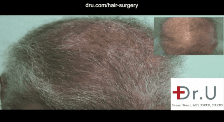 A body hair transplant for impossible repair is able to expand the donor supply, which is critical in cases like this when the head can no longer provide enough grafts. Body hair was used to achieve a normal looking coverage to adequately conceal the scars from past surgeries. A body hair transplant for impossible repair is able to expand the donor supply, which is critical in cases like this when the head can no longer provide enough grafts. Body hair was used to achieve a normal looking coverage to adequately conceal the scars from past surgeries.