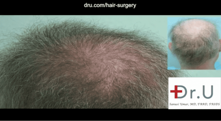 Body hair grafts were used to repair punch graft hair restoration scars and fill in the areas of failed growth from previous surgeries. Body hair grafts were used to repair punch graft hair restoration scars and fill in the areas of failed growth from previous surgeries.