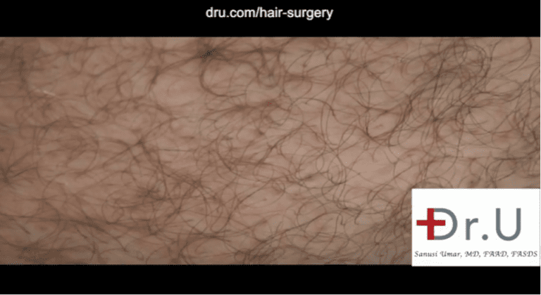 This patient's hair restoration with 10,000 grafts included graft taken from the abdomen. In this photo, a close-up view is shown six months after his surgery. This donor area shows no obvious signs of surgical extractions This patient's hair restoration with 10,000 grafts included graft taken from the abdomen. In this photo, a close-up view is shown six months after his surgery. This donor area shows no obvious signs of surgical extractions