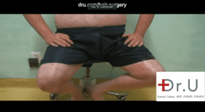Manhattan Beach, Los Angeles patient was able to undergo a body hair transplant for impossible repair where hair was removed from his abdomen, chest, arms, thighs and beard. Here is a photo showing his donor areas in the lower areas of the body. Manhattan Beach, Los Angeles patient was able to undergo a body hair transplant for impossible repair where hair was removed from his abdomen, chest, arms, thighs and beard. Here is a photo showing his donor areas in the lower areas of the body.