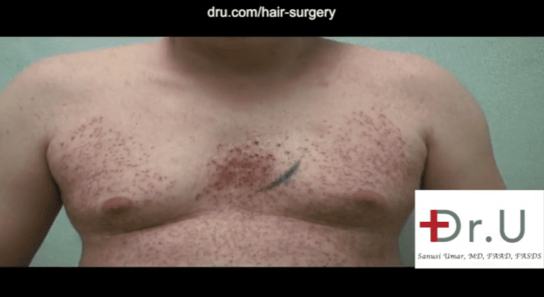 Patient on the last day of his body hair transplant surgery showing his chest after donor grafts were harvested Patient on the last day of his body hair transplant surgery showing his chest after donor grafts were harvested