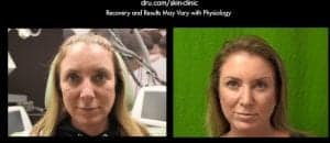 Botox and Dysport can be used for facial wrinkles and eyebrow lifts by relaxing specific muscles Botox and Dysport can be used for facial wrinkles and eyebrow lifts by relaxing specific muscles
