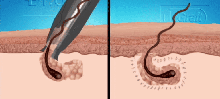 The Dr.UGraft rotary punch can be used on some black patients during a hair transplant procedure. But this application needs to be tested first The Dr.UGraft rotary punch can be used on some black patients during a hair transplant procedure. But this application needs to be tested first