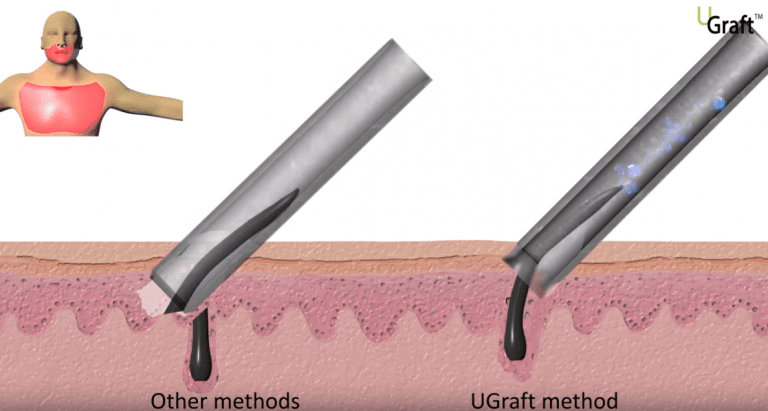 The DrUPunch i™ helps the operator navigate any deviations in follicle path beneath the skin. The DrUPunch i™ helps the operator navigate any deviations in follicle path beneath the skin.