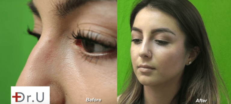 The question of how often should you get fillers may depend on how mobile the treatment area is The question of how often should you get fillers may depend on how mobile the treatment area is