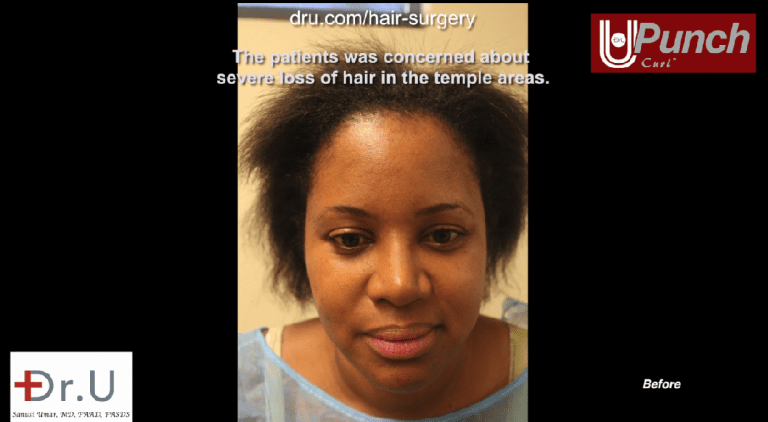 Santa Monica patient hopes to achieve traction alopecia regrowth from her Dr.UPunch Curl hair transplant surgery Santa Monica patient hopes to achieve traction alopecia regrowth from her Dr.UPunch Curl hair transplant surgery