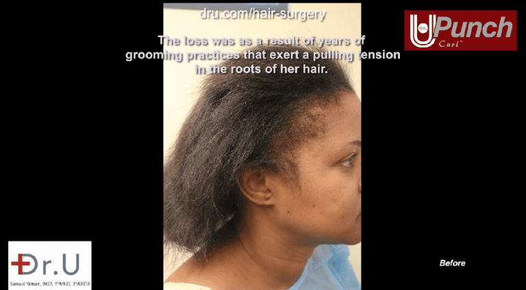 Side view of patient showing thinning edges and temples before her bald edges treatment with the Dr.UPunch Curl Side view of patient showing thinning edges and temples before her bald edges treatment with the Dr.UPunch Curl