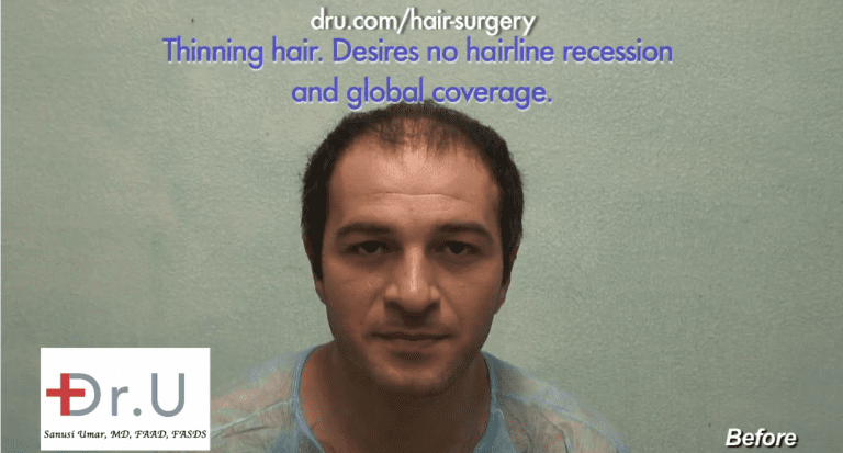 patient with diffuse hair loss before his 10,000 grafts hair transplant with Dr.UGraft patient with diffuse hair loss before his 10,000 grafts hair transplant with Dr.UGraft