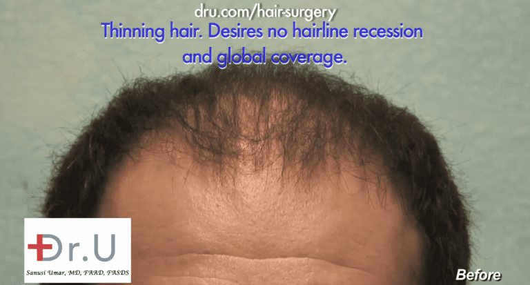 Beverly Hills patient hopes to achieve a low hairline to overcome recession Beverly Hills patient hopes to achieve a low hairline to overcome recession