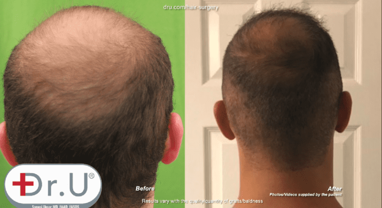 Patient was able to fill in his crown as a result of his Dr.UGraft early 20's hair transplant Patient was able to fill in his crown as a result of his Dr.UGraft early 20's hair transplant