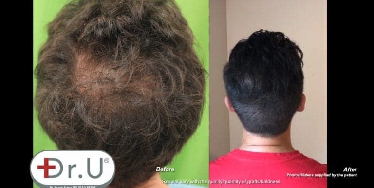 Patient's vertex hair transplant results show a natural looking fuller crown, with no obvious signs of hair loss Patient's vertex hair transplant results show a natural looking fuller crown, with no obvious signs of hair loss
