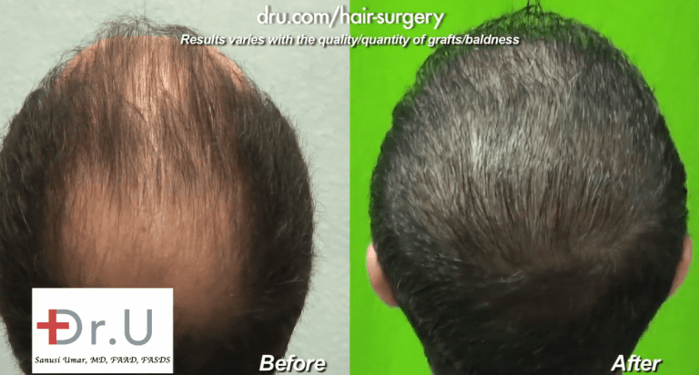 The Dr.UGraft's thinning hair transplant results shown in the crown and top of the scalp The Dr.UGraft's thinning hair transplant results shown in the crown and top of the scalp