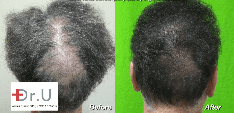 Beard hair grafts fill in crown slot from scalp reduction to produce seamless looking results Beard hair grafts fill in crown slot from scalp reduction to produce seamless looking results