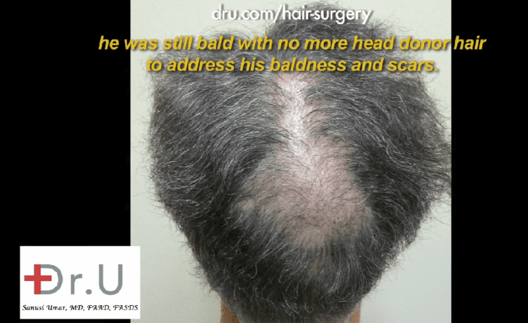 Additional donor resources are needed to fill in crown slot from scalp reduction Additional donor resources are needed to fill in crown slot from scalp reduction