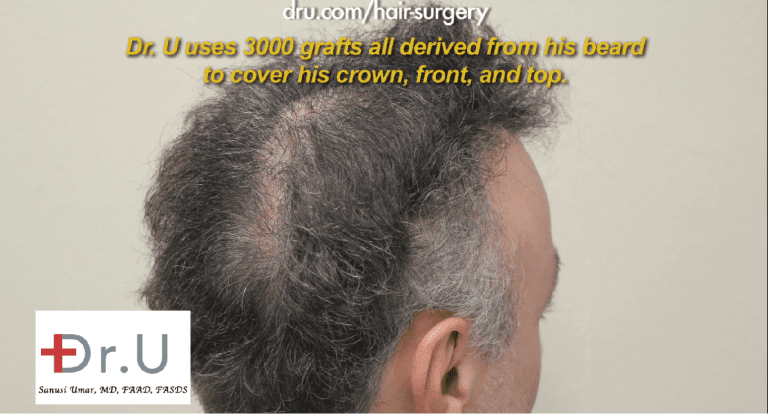 This patient required a slot deformity repair using additional donor grafts derived from non-head hair areas This patient required a slot deformity repair using additional donor grafts derived from non-head hair areas