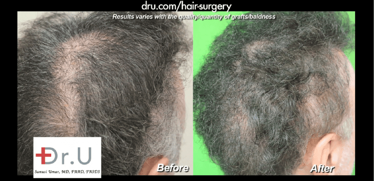 Pasadena patient before and after his Dr.UGraft scalp reduction repair Pasadena patient before and after his Dr.UGraft scalp reduction repair