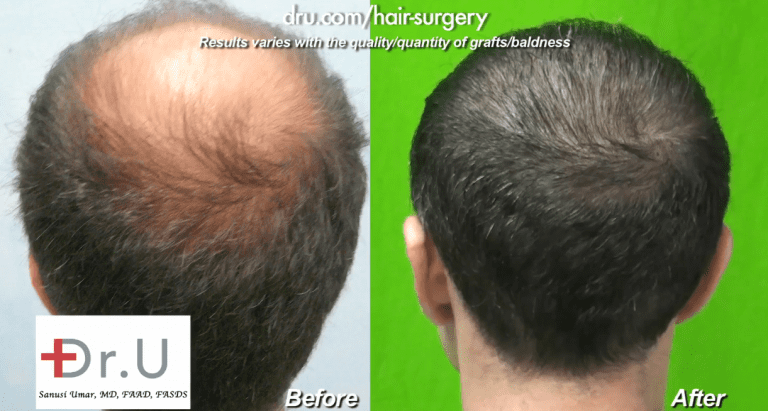 Image of the patient's crown hair transplant before and after Image of the patient's crown hair transplant before and after