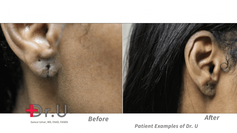 This Hollywood, Los Angeles patient approached Dr. Umar about her torn earlobe; after the repair procedure at Dr. U Skin Clinic, she was interested in safe earrings for split earlobes. This Hollywood, Los Angeles patient approached Dr. Umar about her torn earlobe; after the repair procedure at Dr. U Skin Clinic, she was interested in safe earrings for split earlobes.