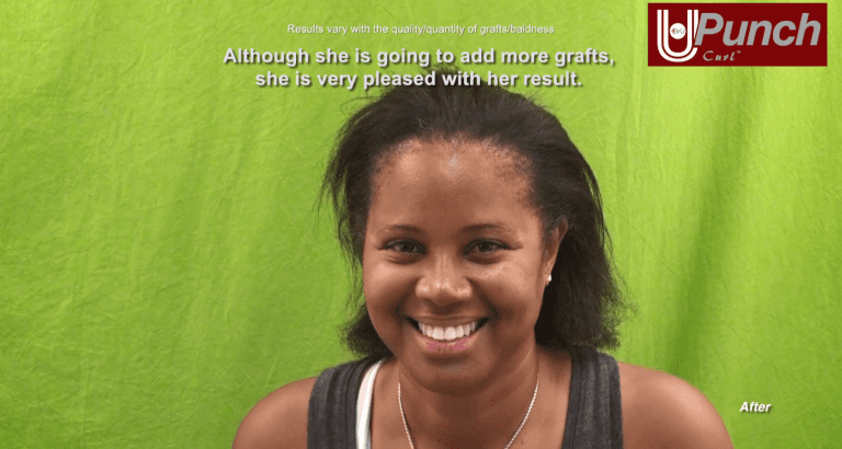 Santa Monica patient is now a firm believer that the Dr.UPunch Curl™ offers the best treatment for traction alopecia Santa Monica patient is now a firm believer that the Dr.UPunch Curl™ offers the best treatment for traction alopecia