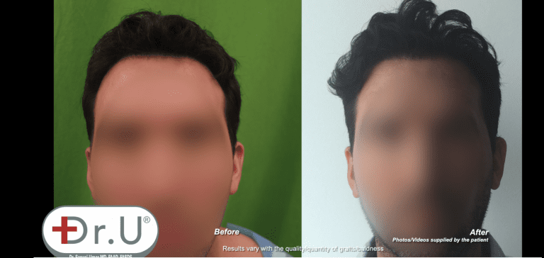 Patient achieved far more than just a hair transplant scar cover-up, but a whole new appearance that he can feel confident about Patient achieved far more than just a hair transplant scar cover-up, but a whole new appearance that he can feel confident about