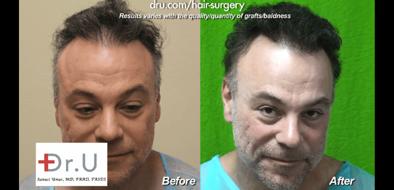 This patient finally found an ideal means to repair a crown slot from scalp reduction surgery which gave him a very natural looking outcome in the end This patient finally found an ideal means to repair a crown slot from scalp reduction surgery which gave him a very natural looking outcome in the end